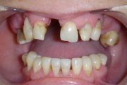 Widoczne braki zębowe i ubytki tkanek miękkich