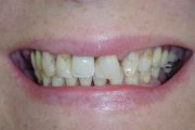 Sytuacja wyjściowa- brakujące zęby uzupełnione akrylową protezą