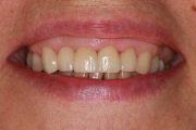 Korony pełnoceramiczne 13-22, wypełnienia kompozytowe sąsiednich zębów